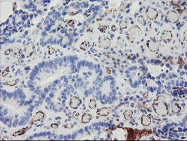 PECAM-1 / CD31 Antibody - IHC of paraffin-embedded Adenocarcinoma of Human colon tissue using anti-PECAM1 mouse monoclonal antibody. (Heat-induced epitope retrieval by 10mM citric buffer, pH6.0, 100C for 10min).