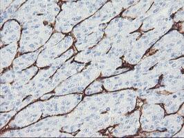 PECAM-1 / CD31 Antibody - IHC of paraffin-embedded Carcinoma of Human liver tissue using anti-PECAM1 mouse monoclonal antibody. (Heat-induced epitope retrieval by 10mM citric buffer, pH6.0, 100C for 10min).
