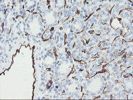 PECAM-1 / CD31 Antibody - IHC of paraffin-embedded Carcinoma of Human thyroid tissue using anti-PECAM1 mouse monoclonal antibody. (Heat-induced epitope retrieval by 10mM citric buffer, pH6.0, 100C for 10min).