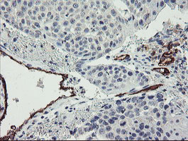 PECAM-1 / CD31 Antibody - IHC of paraffin-embedded Carcinoma of Human lung tissue using anti-PECAM1 mouse monoclonal antibody.