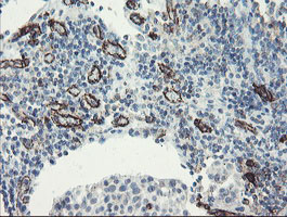 PECAM-1 / CD31 Antibody - IHC of paraffin-embedded Carcinoma of Human bladder tissue using anti-PECAM1 mouse monoclonal antibody.