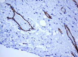 PECAM-1 / CD31 Antibody - IHC of paraffin-embedded Adenocarcinoma of Human breast tissue using anti-PECAM1 mouse monoclonal antibody. (Heat-induced epitope retrieval by 10mM citric buffer, pH6.0, 120°C for 3min).