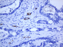 PECAM-1 / CD31 Antibody - IHC of paraffin-embedded Adenocarcinoma of Human colon tissue using anti-PECAM1 mouse monoclonal antibody. (Heat-induced epitope retrieval by 10mM citric buffer, pH6.0, 120°C for 3min).