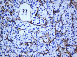 PECAM-1 / CD31 Antibody - IHC of paraffin-embedded Carcinoma of Human kidney tissue using anti-PECAM1 mouse monoclonal antibody. (Heat-induced epitope retrieval by 10mM citric buffer, pH6.0, 120°C for 3min).