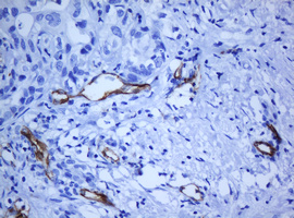 PECAM-1 / CD31 Antibody - IHC of paraffin-embedded Carcinoma of Human liver tissue using anti-PECAM1 mouse monoclonal antibody. (Heat-induced epitope retrieval by 10mM citric buffer, pH6.0, 120°C for 3min).