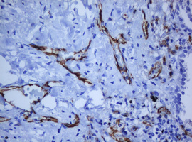 PECAM-1 / CD31 Antibody - IHC of paraffin-embedded Carcinoma of Human lung tissue using anti-PECAM1 mouse monoclonal antibody. (Heat-induced epitope retrieval by 10mM citric buffer, pH6.0, 120°C for 3min).