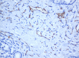 PECAM-1 / CD31 Antibody - IHC of paraffin-embedded Carcinoma of Human thyroid tissue using anti-PECAM1 mouse monoclonal antibody. (Heat-induced epitope retrieval by 10mM citric buffer, pH6.0, 120°C for 3min).