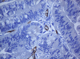 PECAM-1 / CD31 Antibody - IHC of paraffin-embedded Adenocarcinoma of Human endometrium tissue using anti-PECAM1 mouse monoclonal antibody. (Heat-induced epitope retrieval by 10mM citric buffer, pH6.0, 120°C for 3min).