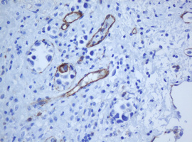 PECAM-1 / CD31 Antibody - IHC of paraffin-embedded Carcinoma of Human bladder tissue using anti-PECAM1 mouse monoclonal antibody. (Heat-induced epitope retrieval by 10mM citric buffer, pH6.0, 120°C for 3min).