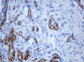 PECAM-1 / CD31 Antibody - IHC of paraffin-embedded Carcinoma of Human pancreas tissue using anti-PECAM1 mouse monoclonal antibody. (Heat-induced epitope retrieval by 10mM citric buffer, pH6.0, 120°C for 3min).