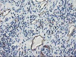 PECAM-1 / CD31 Antibody - IHC of paraffin-embedded Carcinoma of Human kidney tissue using anti-PECAM1 mouse monoclonal antibody.