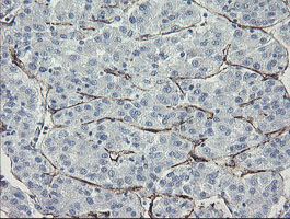 PECAM-1 / CD31 Antibody - IHC of paraffin-embedded Carcinoma of Human liver tissue using anti-PECAM1 mouse monoclonal antibody.