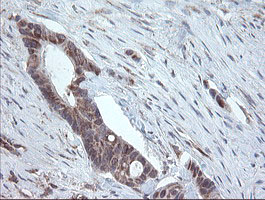 PECAM-1 / CD31 Antibody - IHC of paraffin-embedded Adenocarcinoma of Human colon tissue using anti-PECAM1 mouse monoclonal antibody.