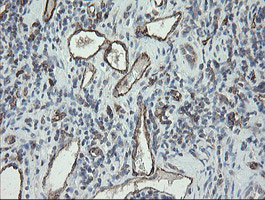 PECAM-1 / CD31 Antibody - IHC of paraffin-embedded Carcinoma of Human kidney tissue using anti-PECAM1 mouse monoclonal antibody.