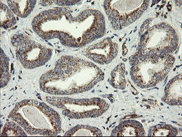 PECAM-1 / CD31 Antibody - IHC of paraffin-embedded Carcinoma of Human prostate tissue using anti-PECAM1 mouse monoclonal antibody.