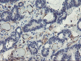 PECAM-1 / CD31 Antibody - IHC of paraffin-embedded Adenocarcinoma of Human colon tissue using anti-PECAM1 mouse monoclonal antibody. (Heat-induced epitope retrieval by 10mM citric buffer, pH6.0, 100C for 10min).