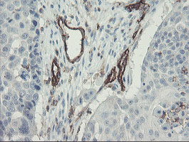 PECAM-1 / CD31 Antibody - IHC of paraffin-embedded Carcinoma of Human lung tissue using anti-PECAM1 mouse monoclonal antibody. (Heat-induced epitope retrieval by 10mM citric buffer, pH6.0, 100C for 10min).