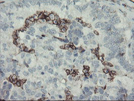 PECAM-1 / CD31 Antibody - IHC of paraffin-embedded Adenocarcinoma of Human ovary tissue using anti-PECAM1 mouse monoclonal antibody. (Heat-induced epitope retrieval by 10mM citric buffer, pH6.0, 100C for 10min).