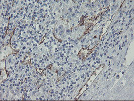 PECAM-1 / CD31 Antibody - IHC of paraffin-embedded Carcinoma of Human liver tissue using anti-PECAM1 mouse monoclonal antibody.