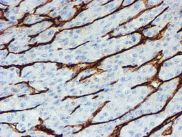 PECAM-1 / CD31 Antibody - IHC of paraffin-embedded Carcinoma of Human liver tissue using anti-PECAM1 mouse monoclonal antibody.
