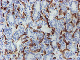 PECAM-1 / CD31 Antibody - IHC of paraffin-embedded Carcinoma of Human thyroid tissue using anti-PECAM1 mouse monoclonal antibody.
