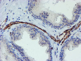 PECAM-1 / CD31 Antibody - IHC of paraffin-embedded Carcinoma of Human prostate tissue using anti-PECAM1 mouse monoclonal antibody.