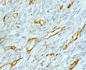 PECAM-1 / CD31 Antibody - IHC testing of colon carcinoma and CD31 antibody (PCM25-1).  This image was taken for the unmodified form of this product. Other forms have not been tested.