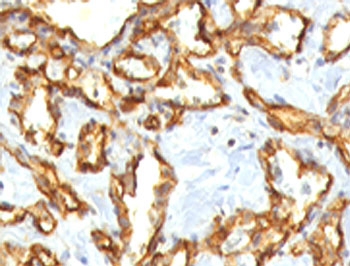 PECAM-1 / CD31 Antibody - IHC staining of FFPE human angiocarcinoma with CD31 antibody (clone RMCD31-1).  This image was taken for the unmodified form of this product. Other forms have not been tested.