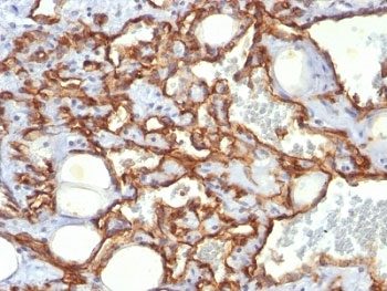 PECAM-1 / CD31 Antibody - Formalin-fixed, paraffin-embedded human Angiosarcoma stained with anti-CD31 antibody (SPM532).  This image was taken for the unmodified form of this product. Other forms have not been tested.