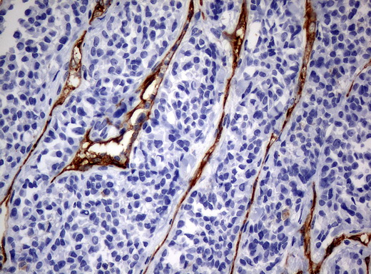 PECAM-1 / CD31 Antibody - Immunohistochemical staining of paraffin-embedded Carcinoma of thyroid tissue using anti-PECAM1mouse monoclonal antibody. (Clone UMAB31, dilution 1:100; heat-induced epitope retrieval by 10mM citric buffer, pH6.0, 120C for 3min)
