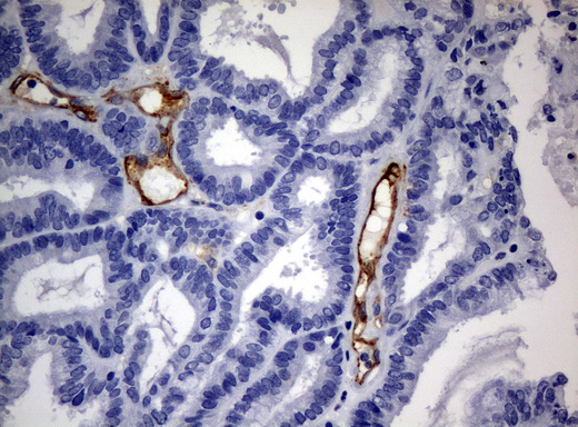 PECAM-1 / CD31 Antibody - Immunohistochemical staining of paraffin-embedded Adenocarcinoma of endometrium tissue using anti-PECAM1mouse monoclonal antibody. (Clone UMAB31, dilution 1:100; heat-induced epitope retrieval by 10mM citric buffer, pH6.0, 120C for 3min)