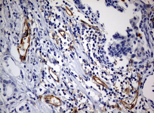 PECAM-1 / CD31 Antibody - Immunohistochemical staining of paraffin-embedded Carcinoma of prostate tissue using anti-PECAM1mouse monoclonal antibody. (Clone UMAB31, dilution 1:100; heat-induced epitope retrieval by 10mM citric buffer, pH6.0, 120C for 3min)