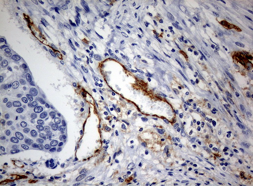 PECAM-1 / CD31 Antibody - Immunohistochemical staining of paraffin-embedded Carcinoma of bladder tissue using anti-PECAM1mouse monoclonal antibody. (Clone UMAB31, dilution 1:100; heat-induced epitope retrieval by 10mM citric buffer, pH6.0, 120C for 3min)