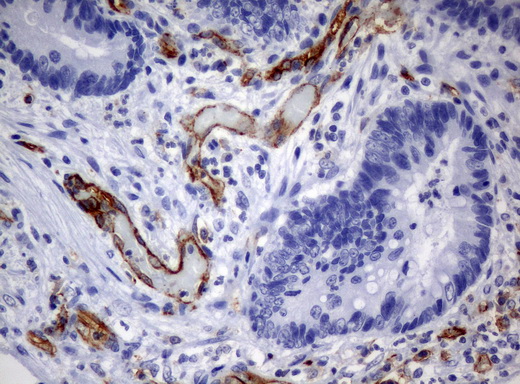 PECAM-1 / CD31 Antibody - Immunohistochemical staining of paraffin-embedded Adenocarcinoma of colon tissue using anti-PECAM1mouse monoclonal antibody. (Clone UMAB31, dilution 1:100; heat-induced epitope retrieval by 10mM citric buffer, pH6.0, 120C for 3min)