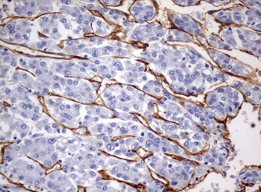PECAM-1 / CD31 Antibody - Immunohistochemical staining of paraffin-embedded Carcinoma of liver tissue using anti-PECAM1mouse monoclonal antibody. (Clone UMAB31, dilution 1:100; heat-induced epitope retrieval by 10mM citric buffer, pH6.0, 120C for 3min)