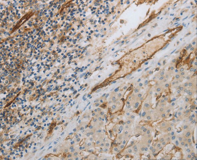 PECAM-1 / CD31 Antibody - Immunohistochemistry of paraffin-embedded Human liver cancer using PECAM1 Polyclonal Antibody at dilution of 1:30.