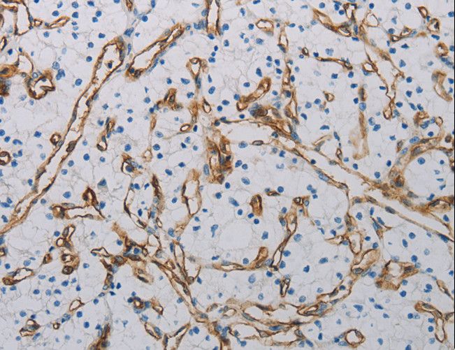 PECAM-1 / CD31 Antibody - Immunohistochemistry of paraffin-embedded Human thyroid cancer using PECAM1 Polyclonal Antibody at dilution of 1:40.