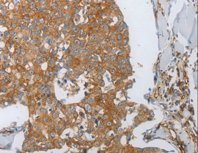 PECAM-1 / CD31 Antibody - Immunohistochemistry of paraffin-embedded Human breast cancer using PECAM1 Polyclonal Antibody at dilution of 1:30.