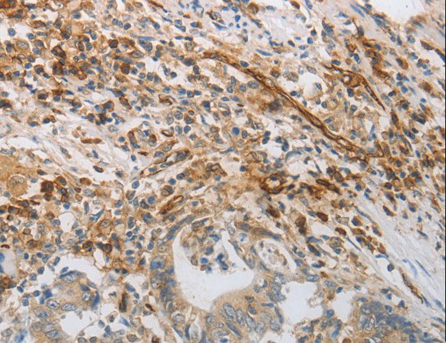 PECAM-1 / CD31 Antibody - Immunohistochemistry of paraffin-embedded Human colon cancer using PECAM1 Polyclonal Antibody at dilution of 1:30.
