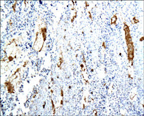 PECAM-1 / CD31 Antibody - CD31 staining in mouse melanoma. Paraffin-embedded mouse melanoma cells are stained with CD31 Antibody used at 1:200 dilution.