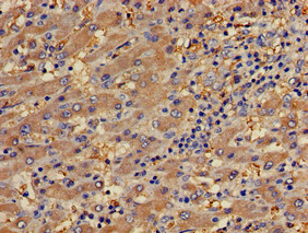 PECAM-1 / CD31 Antibody - Immunohistochemistry of paraffin-embedded human liver cancer using PECAM1 Antibody at dilution of 1:100