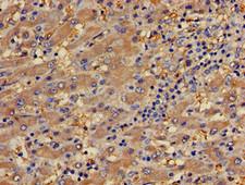 PECAM-1 / CD31 Antibody - Immunohistochemistry of paraffin-embedded human liver cancer using PECAM1 Antibody at dilution of 1:100