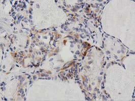 PECR Antibody - IHC of paraffin-embedded Carcinoma of Human thyroid tissue using anti-PECR mouse monoclonal antibody. (Dilution 1:50).