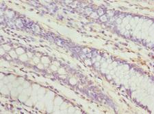 PECR Antibody - Immunohistochemistry of paraffin-embedded human colon cancer at dilution 1:100