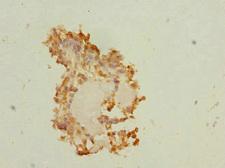 PEG1 / MEST Antibody - Immunohistochemistry of paraffin-embedded human breast cancer at dilution 1:100