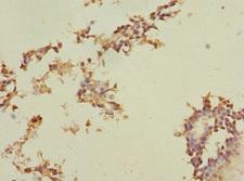 PEG1 / MEST Antibody - Immunohistochemistry of paraffin-embedded human breast cancer at dilution 1:100
