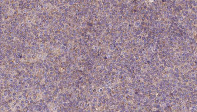 PEG1 / MEST Antibody - 1:100 staining human lymph carcinoma tissue by IHC-P. The sample was formaldehyde fixed and a heat mediated antigen retrieval step in citrate buffer was performed. The sample was then blocked and incubated with the antibody for 1.5 hours at 22°C. An HRP conjugated goat anti-rabbit antibody was used as the secondary.