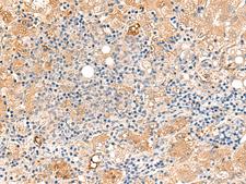 PEG1 / MEST Antibody - Immunohistochemistry of paraffin-embedded Human liver cancer tissue  using MEST Polyclonal Antibody at dilution of 1:50(×200)