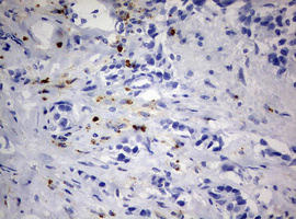 PEG3 Antibody - IHC of paraffin-embedded Adenocarcinoma of Human breast tissue using anti-PEG3 mouse monoclonal antibody.