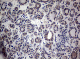 PEG3 Antibody - IHC of paraffin-embedded Carcinoma of Human thyroid tissue using anti-PEG3 mouse monoclonal antibody.
